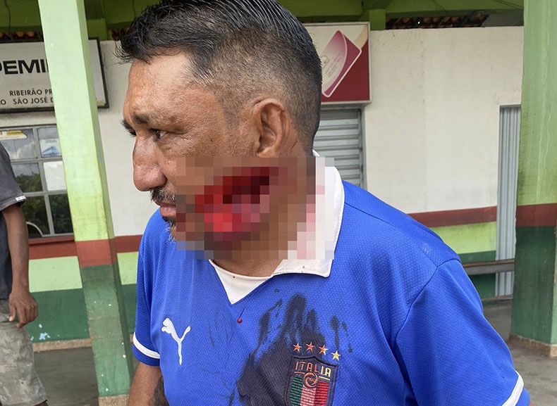 Homem que teve parte do rosto arrancado com facão morre em Picos