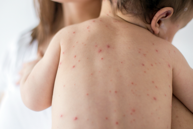 Sesapi monitora caso importado de sarampo em Campo Grande do Piauí