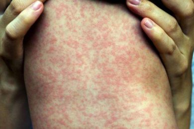 Terceiro caso de sarampo importado é confirmado no Piauí