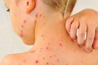 Piauí investiga oito casos suspeitos de sarampo, revela Ministério da Saúde