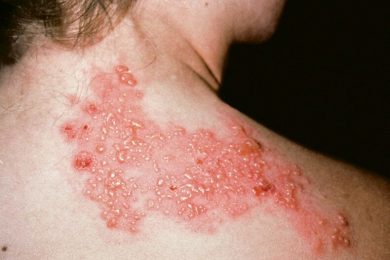 Casos de “cobreiro” deixam população de Picos em alerta